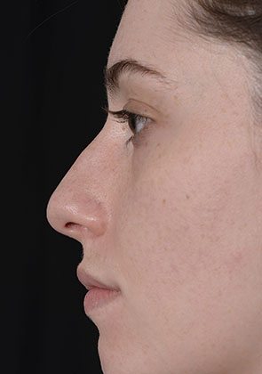 Rhinoplasty before surgery ppc