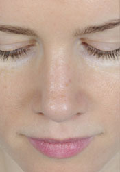 Rhinoplasty After Surgery2