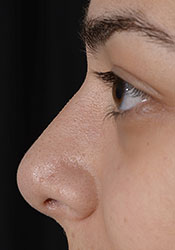 Rhinoplasty After Surgery3