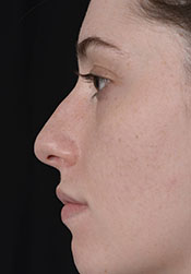 Rhinoplasty Before Surgery1