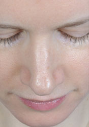 Rhinoplasty Before Surgery2