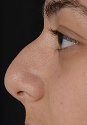 Rhinoplasty Before Surgery3