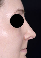 Rhinoplasty After Surgery2