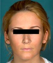 rhinoplasty afterA110309