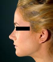 rhinoplasty afterB110309