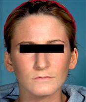 rhinoplasty beforeA110309