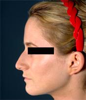 rhinoplasty beforeB110309