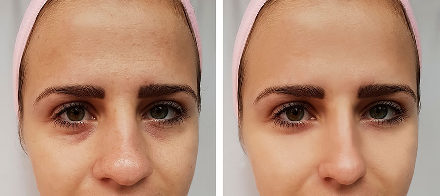 Broken during rhinoplasty