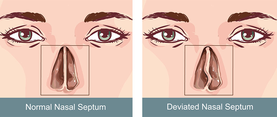 Septoplasty for deviated nasal septum