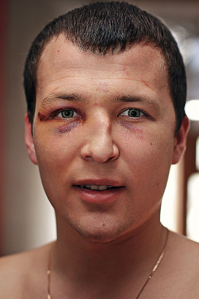 rhinoplasty saddle nose