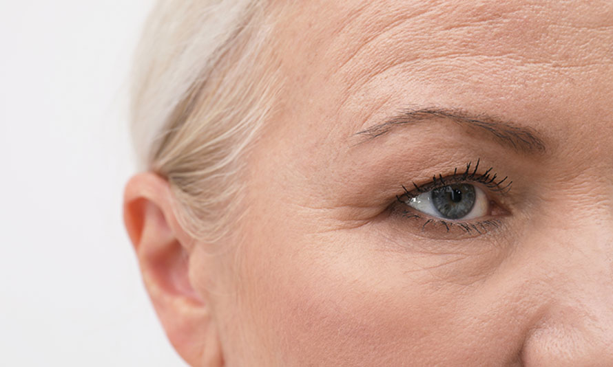 lateral browlift endoscopic browlift