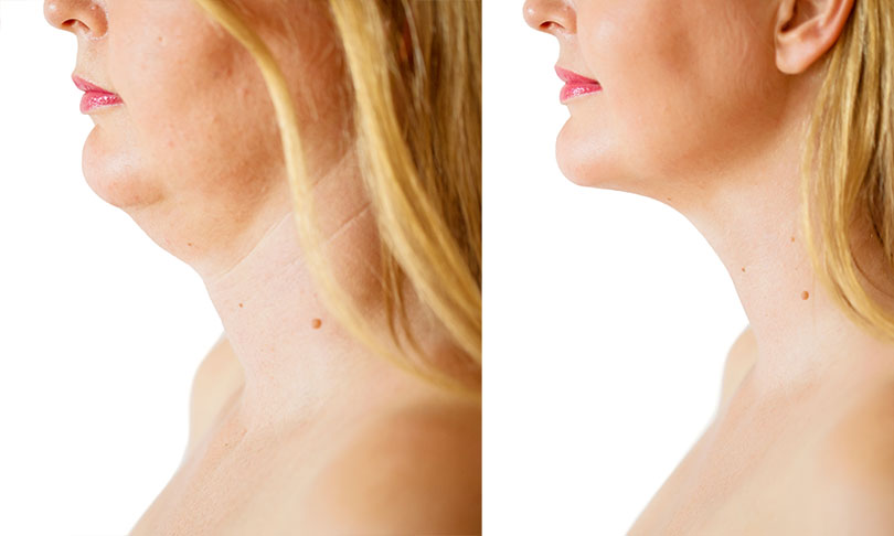 what problems neck lift