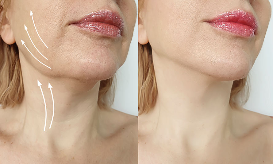 how to get rid of jowls